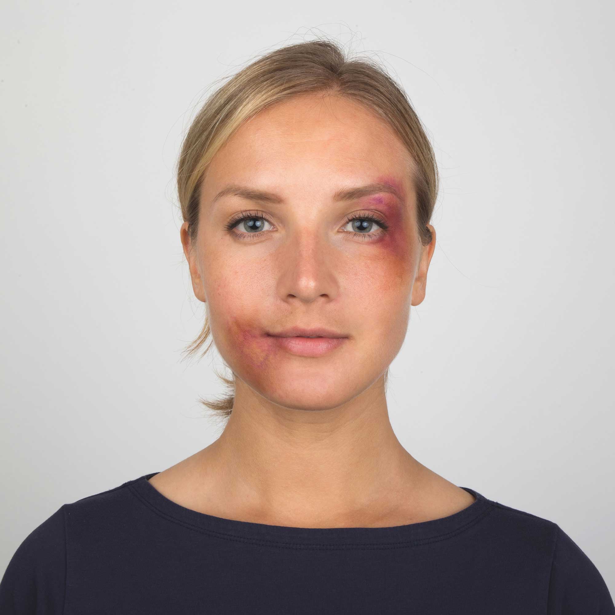 Model with subtle bruise SFX makeup applied with Starter Effects Kit